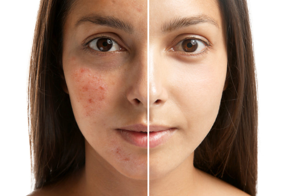 Woman face before and after acne treatment procedure at Evolve Skin